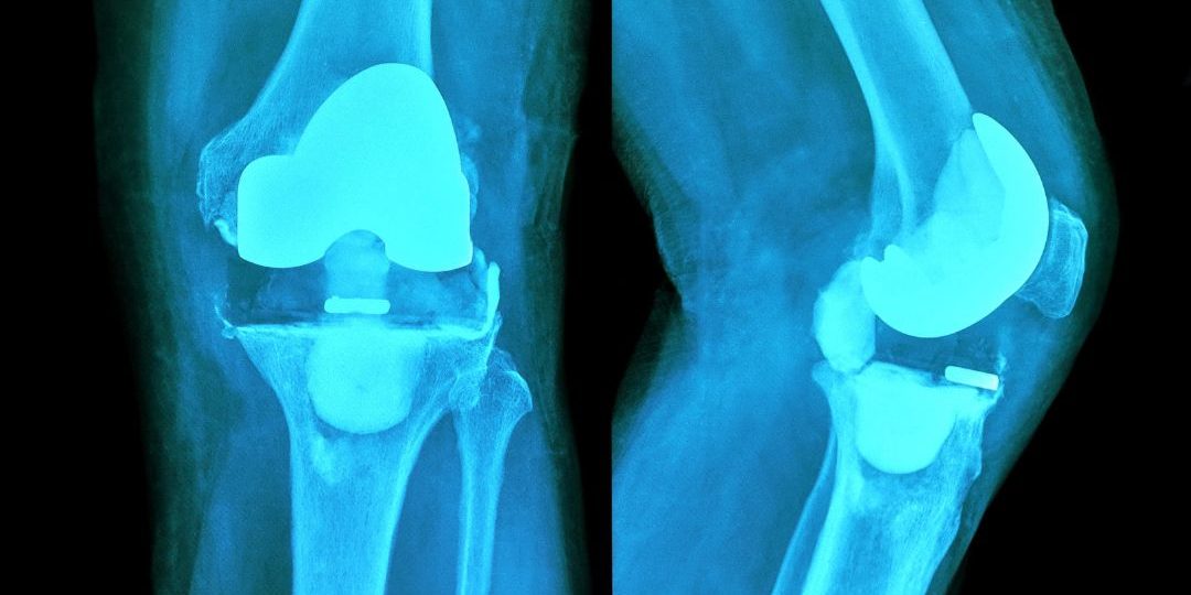 protesis-de-rodilla