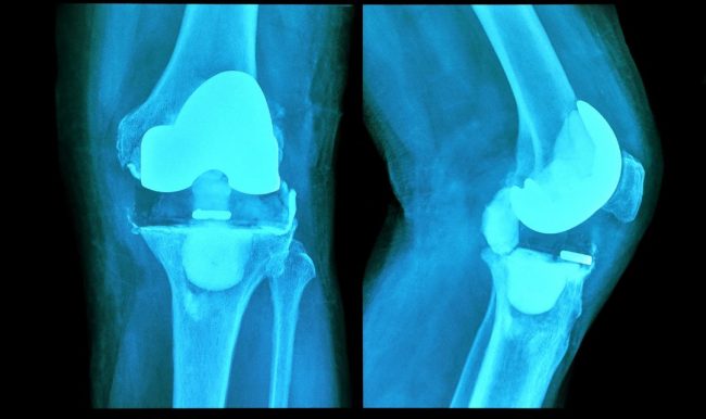 protesis-de-rodilla