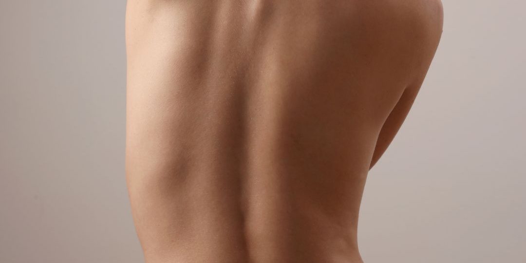 escoliosis